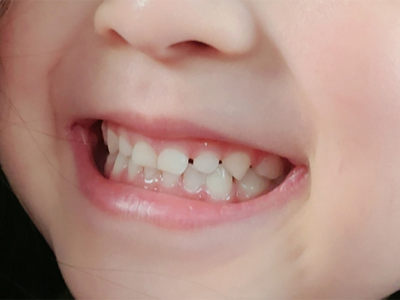 お子様の矯正治療について